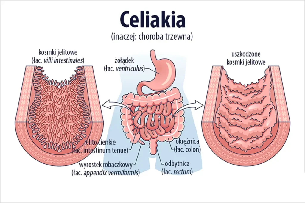 co to jest celiakia