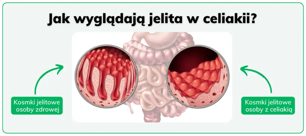 co to jest celiakia